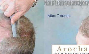 Left view - Before and after hair transplantation images