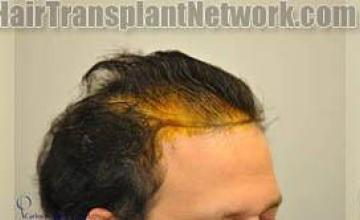 Hair restoration procedure result images