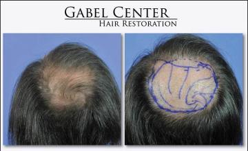 Hair restoration procedure before and after pictures