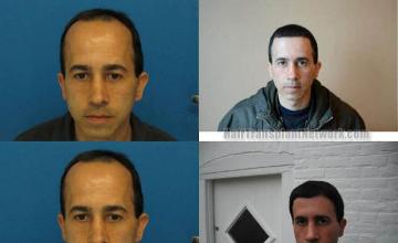 Hair transplantation surgery before and after photos