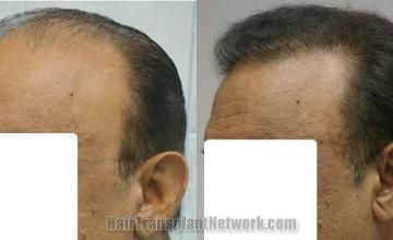 Left view - Before and after hair transplantation photos