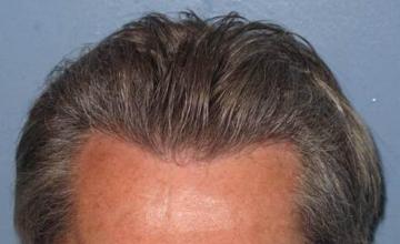 Closeup front view photo of hairline 6 months postoperative