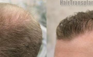 Hair transplantation surgery before and after pictures