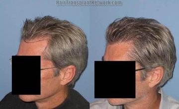 Hair restoration procedure before and postoperative image