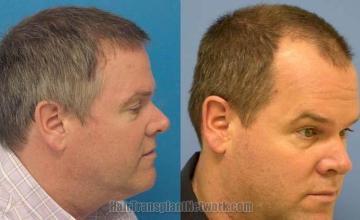 Right view before and after hair restoration images