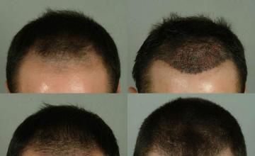 Tilt down view before and after hair restoration pictures