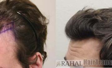 Hair restoration procedure before and after pictures