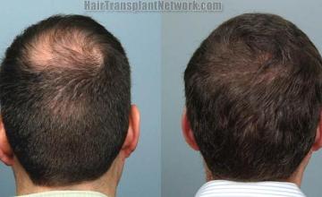 Hair replacement surgery before and after images