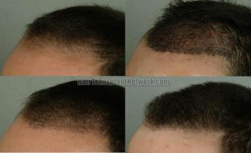 Hair restoration procedure results