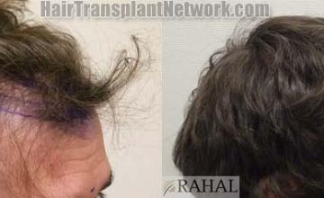 Before and after hair transplant procedure images