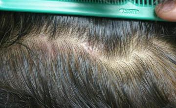 Residual scar postoperative from hair transplantation