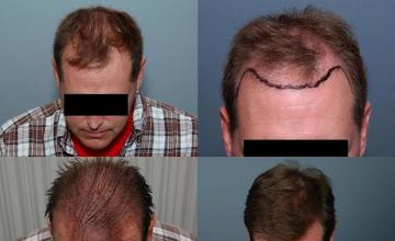 Tilt down view before and after hair restoration pictures