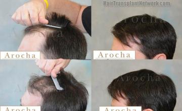 Left view - Before and after hair transplantation images