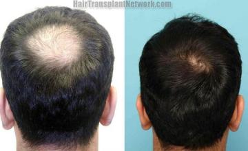 Before and after hair transplantation procedure 