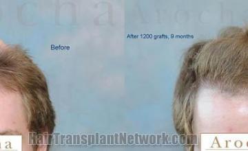 Hair transplantation surgery before and after photos