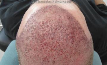 Hair restoration procedure before and after pictures