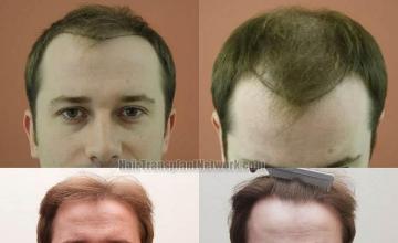 Hair transplantation surgery before and after pictures