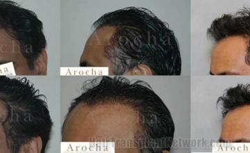 Hair transplant procedure left view before and after images