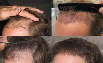 Hair transplantation surgery before and after photos