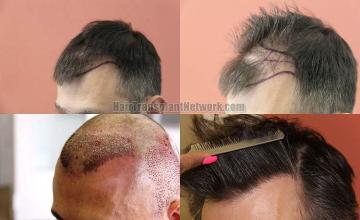 Hair transplantation surgery before and after photos