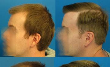 Hair transplantation surgery before and after pictures