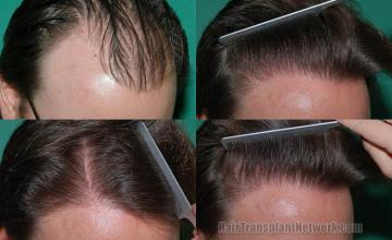 Hair restoration procedure before and after results