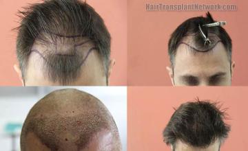 Top view before and after hair restoration results