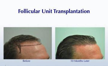 Hair restoration surgery before and after images