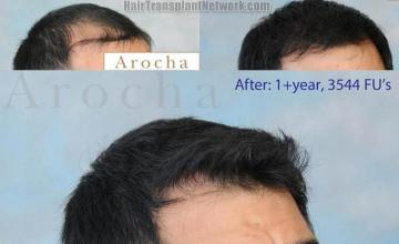 Hair transplantation surgery before and after images