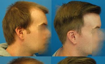 Hair transplantation surgery before and after images