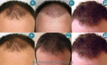 Before and after  photos