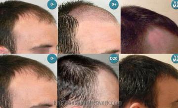  before and after right view images