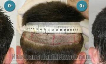 Hair restoration session back view photos