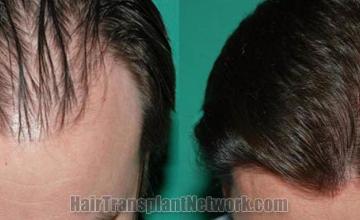 Top view before and after hair restoration results