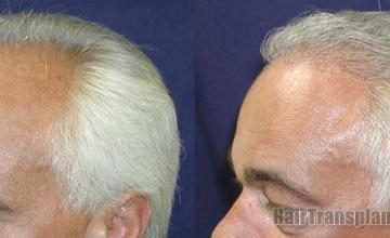  before and after images