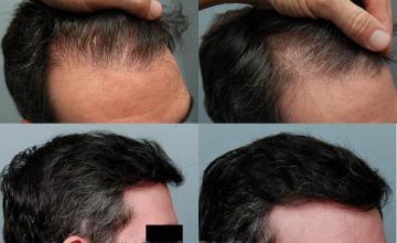 Right view - Before and after hair transplant result image