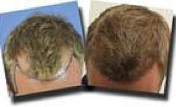 Hair transplantation surgery before and after pictures