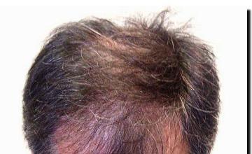 Hair restoration procedure results