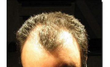 Hair restoration procedure results