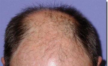 Hair restoration procedure results