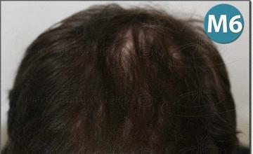 Hair restoration procedure results