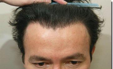 Hair restoration procedure results