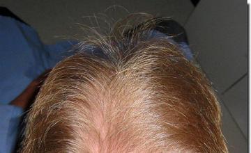 Hair restoration procedure results