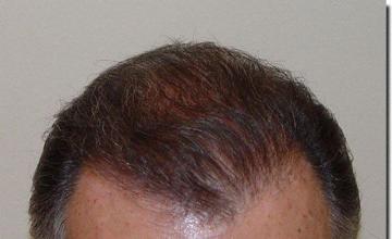 Hair restoration procedure results