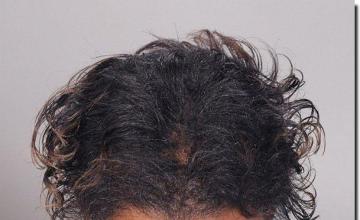 Hair restoration procedure results