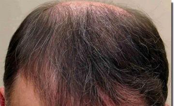 Hair restoration procedure results