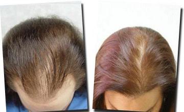 Hair restoration procedure results