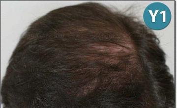 Hair restoration procedure results