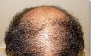 Hair restoration procedure results