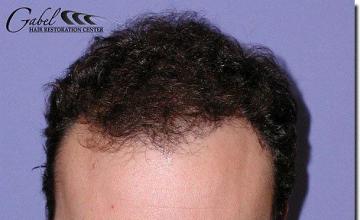 Hair restoration procedure results